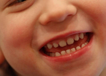 列 費用 矯正 歯 子供 歯列矯正の費用を全て解説！大人や子供、部分矯正から保険診療まで