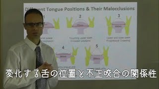 変化する舌の位置と不正咬合の関係性